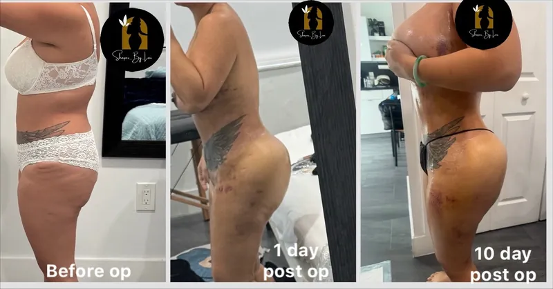 Client photos labeled before op, 1 day post op and 10 day post op
