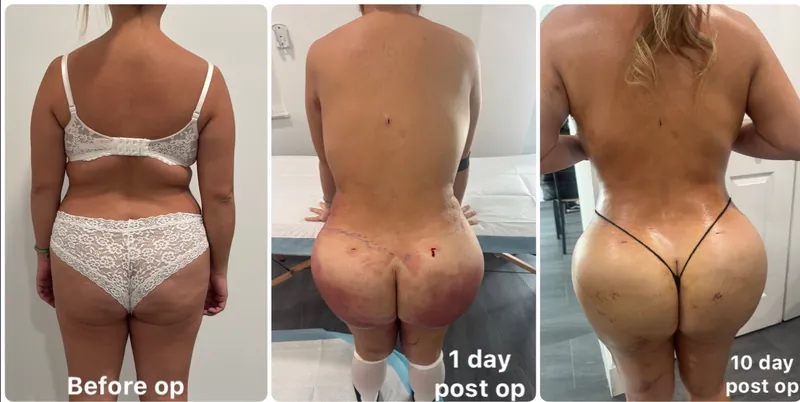Client back photos labeled before op, 1 day post op and 10 day post op
